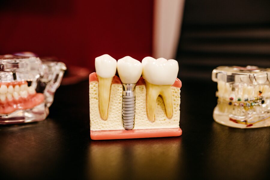 An In-Depth Guide to Dental Implants
