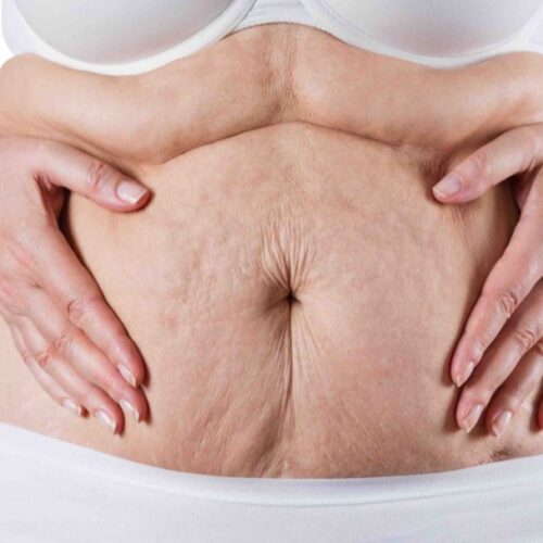 Liposuction vs Tummy Tuck for a Flatter Stomach